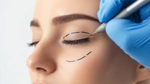 Read more about the article Does Eyelid Surgery Leave Visible Scars