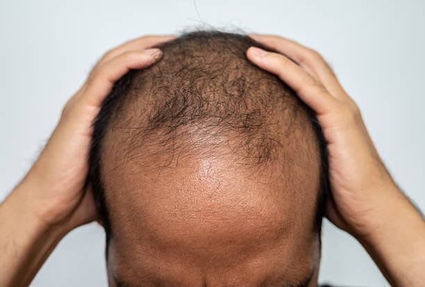 You are currently viewing Does GFC Treatment for Hair Regrow Hair?