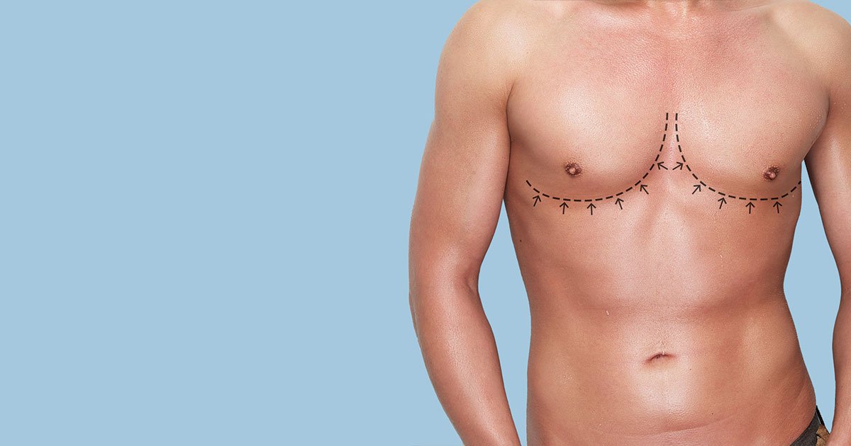 You are currently viewing Does Gynecomastia Surgery Affect Sensation in Chest
