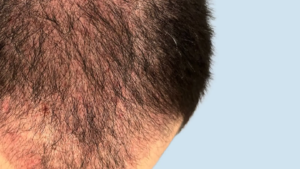 Read more about the article Does Hair Transplant Look Natural After Healing