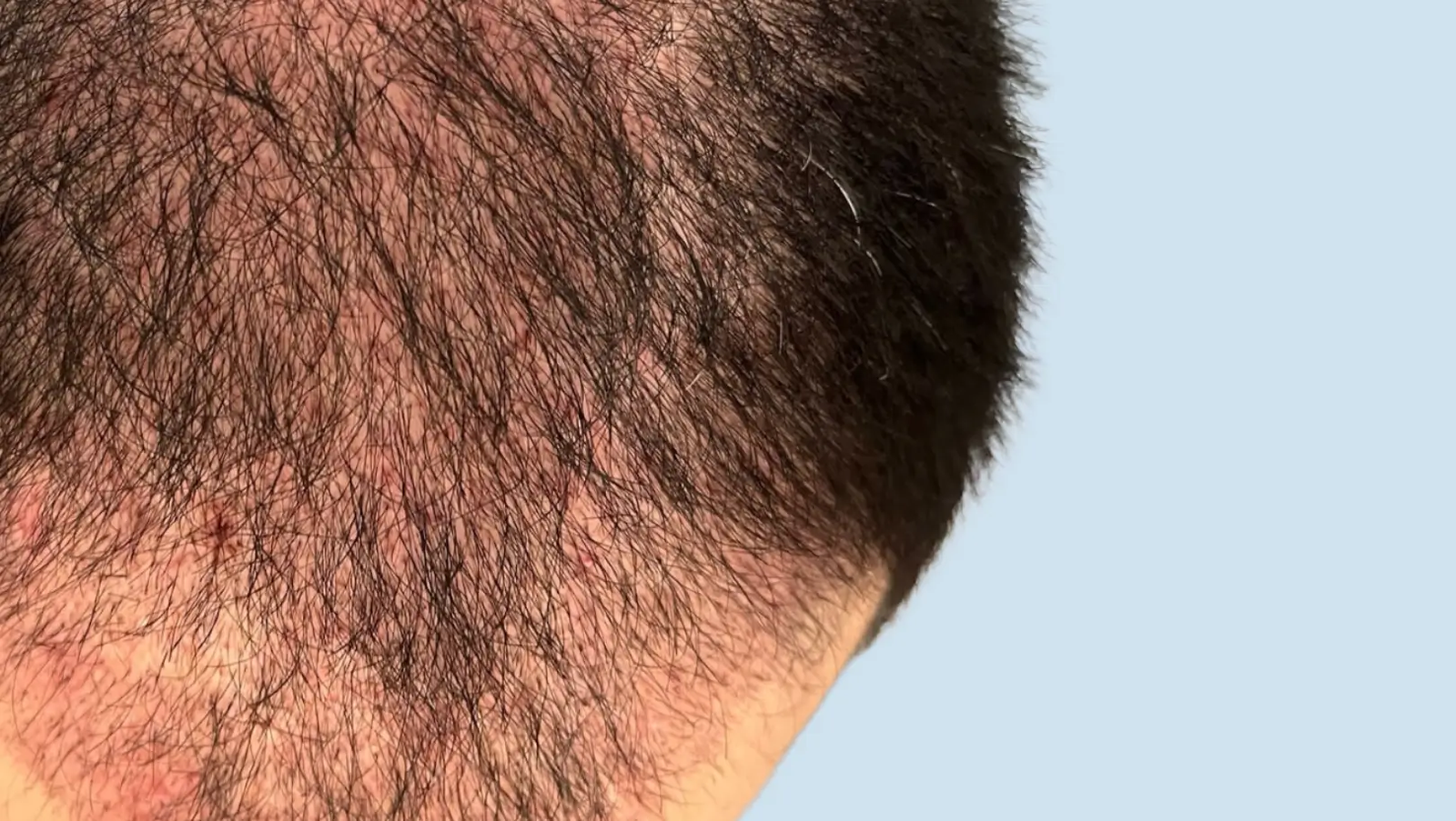You are currently viewing Does Hair Transplant Look Natural After Healing