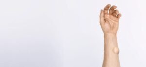 Read more about the article Does Lipoma Treatment Require Multiple Sessions