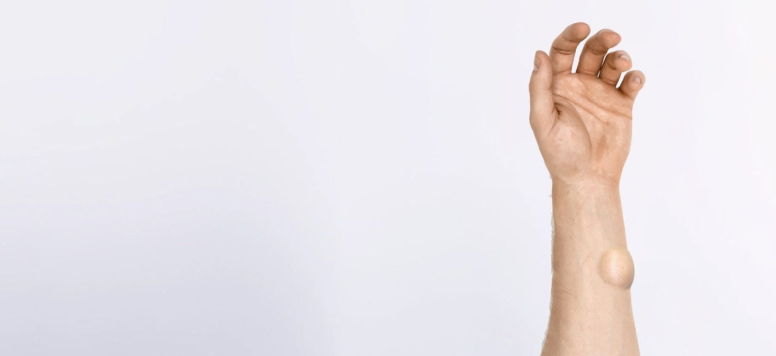 You are currently viewing Does Lipoma Treatment Require Multiple Sessions