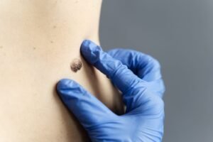Read more about the article Does Mole Removal Require Medical Consultation