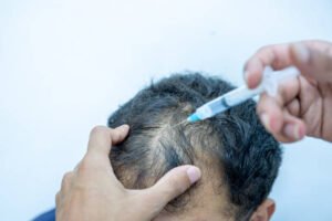 Read more about the article Does Stem Cell Hair Transplant Regrow Lost Hair?