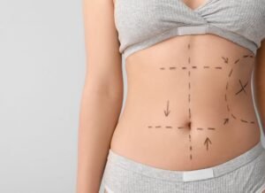Read more about the article Dose Liposuction Surgery Help Improve Body Shape