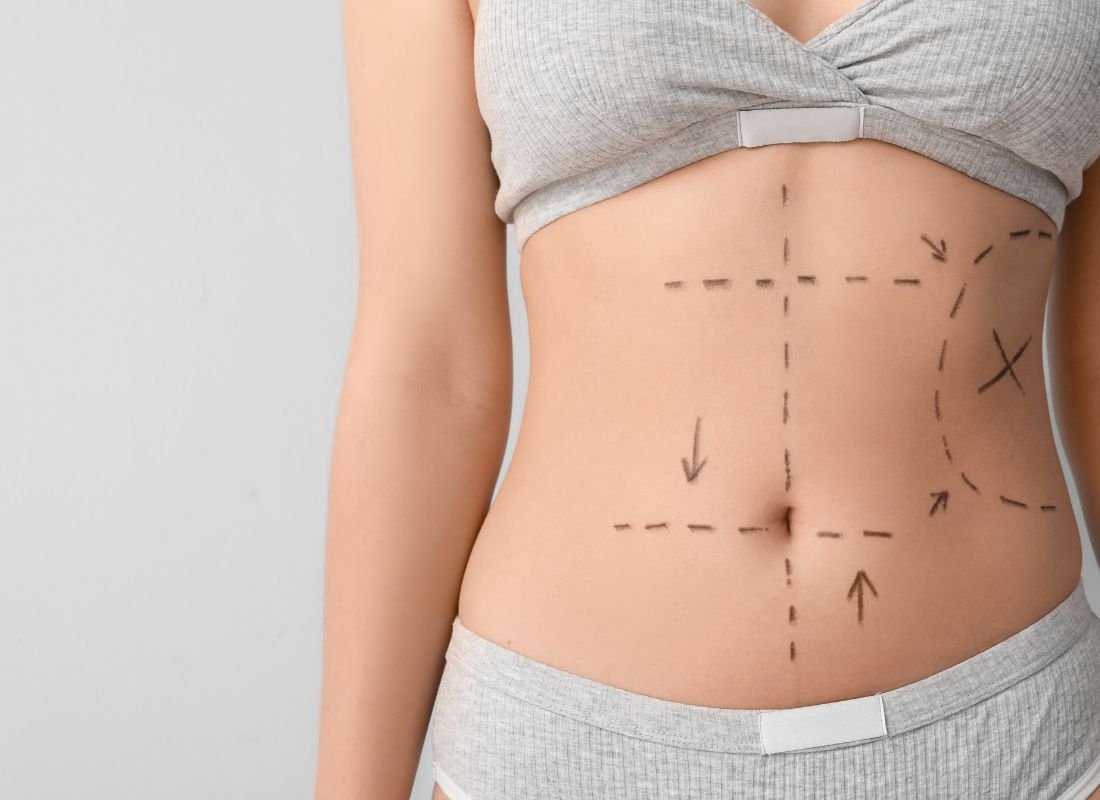 You are currently viewing Dose Liposuction Surgery Help Improve Body Shape