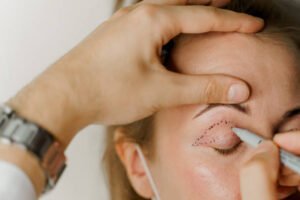 Read more about the article Eyelid Surgery Guide to Beginner’s for Fresh Looks