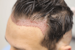 Read more about the article Hair Transplant Advanced Technology for Best Results