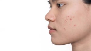 Read more about the article How Effective Is Acne Treatment for Adults