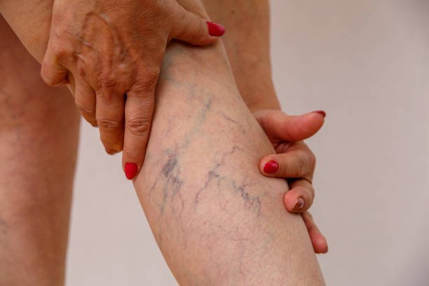 Read more about the article How Long Do Results From Sclerotherapy Usually Last?