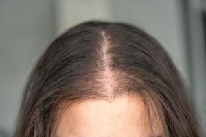 Read more about the article How Long Does Hair Loss Treatment Takes