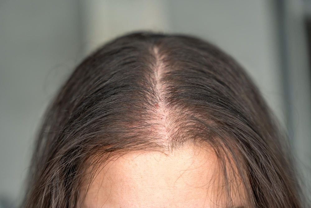 You are currently viewing How Long Does Hair Loss Treatment Takes