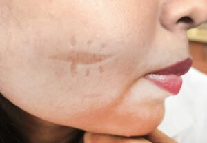 Read more about the article How Many Sessions Are Needed for Facial Scar Revision ?