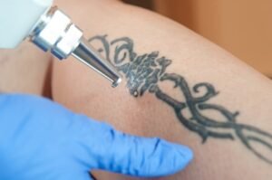 Read more about the article How Soon Can You See Tattoo Removal Results