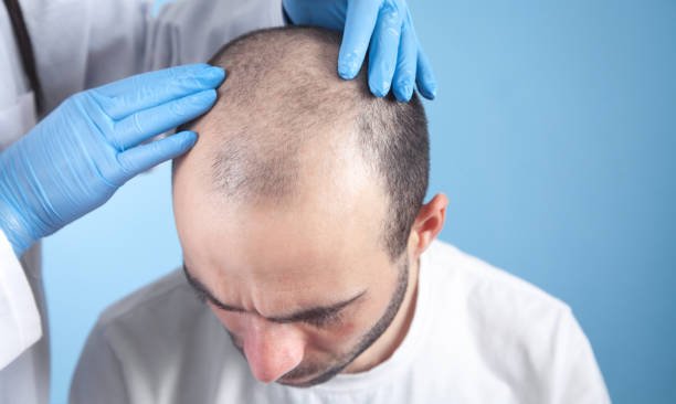 You are currently viewing Is Hair Transplant Effective for Bald Patches