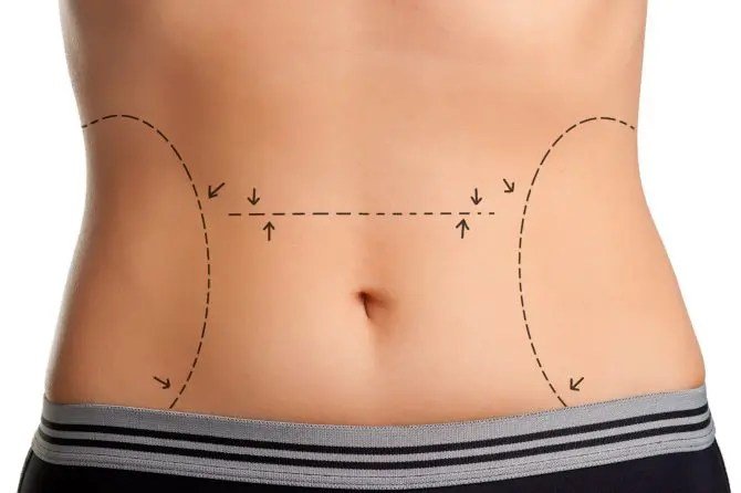 You are currently viewing Is Lipo Abdominoplasty Suitable for Men and Women