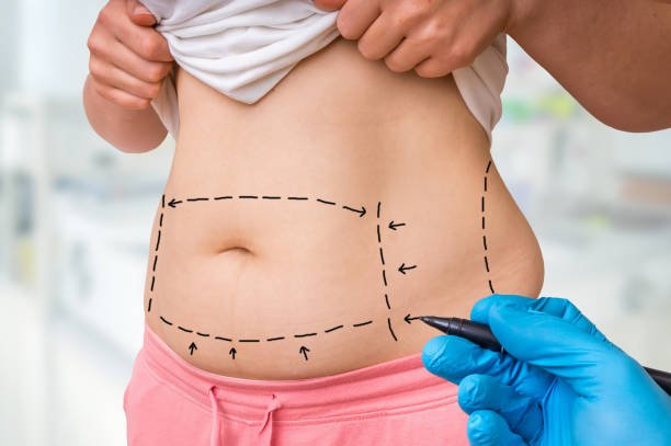 You are currently viewing Is Liposuction a Weight Loss Solution?