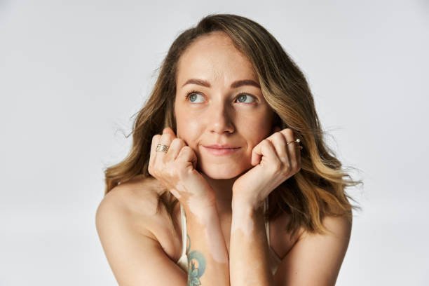 You are currently viewing Is Vitiligo Treatment Covered by Most Health Plans