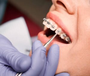 Read more about the article Your Guide to Finding the Best Orthodontist on the Upper East Side