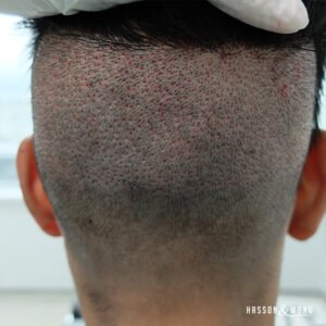 Read more about the article Modern Hair Restoration with FUE Hair Transplant