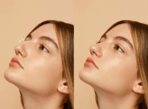 Read more about the article Dubai Rhinoplasty Surgeon: Transform Your Nose with Care