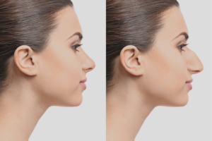 Read more about the article Is Non-Surgical Nose Job the Quick Way to a Sleek and Elegant Nose