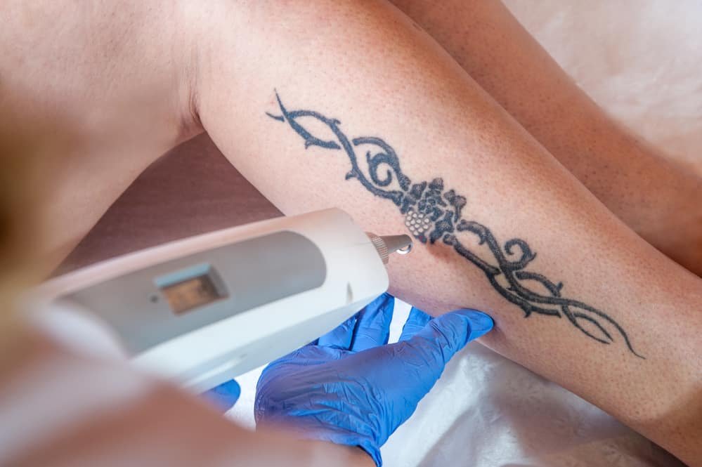 You are currently viewing Precision Laser Tattoo Removal for All Skin Types