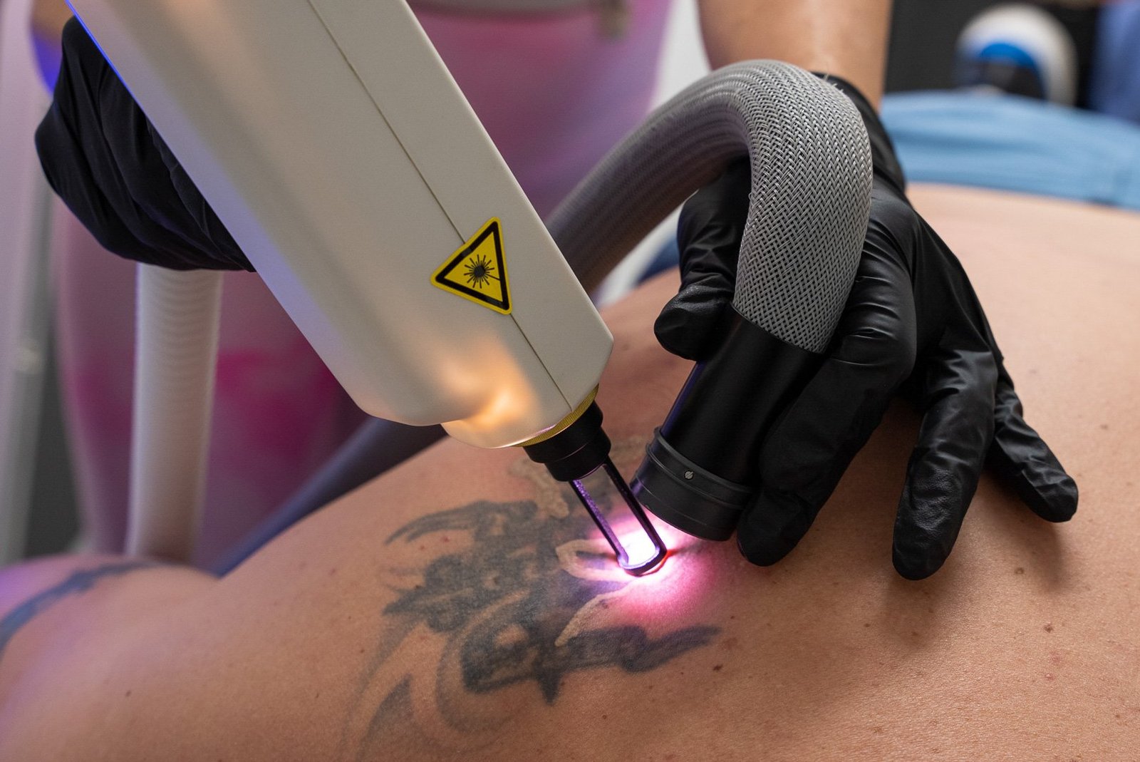 You are currently viewing Restore Smooth Skin with Laser Tattoo Removal