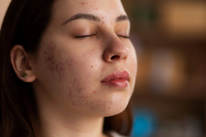Read more about the article Target Acne at Its Source with Treatment