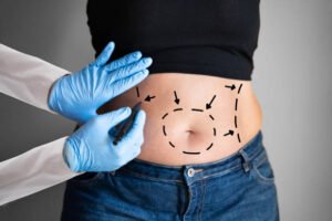 Read more about the article What Can You Expect After a Mini Tummy Tuck Surgery