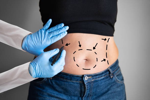 You are currently viewing What Can You Expect After a Mini Tummy Tuck Surgery