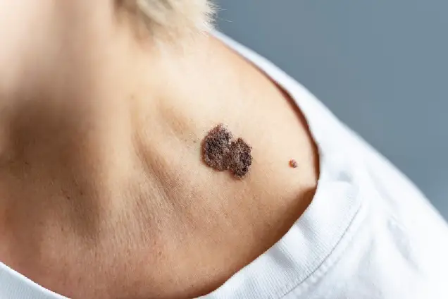 You are currently viewing What Types of Moles Need Removal