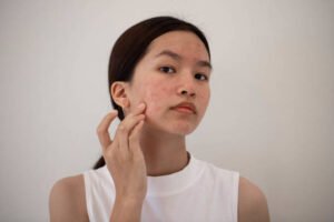 Read more about the article What to Expect from Laser Acne Scar treatment ?