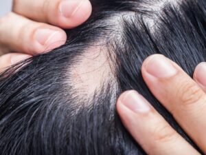 Read more about the article جرعة علاج داء الثعلبة سريعة المفعول؟