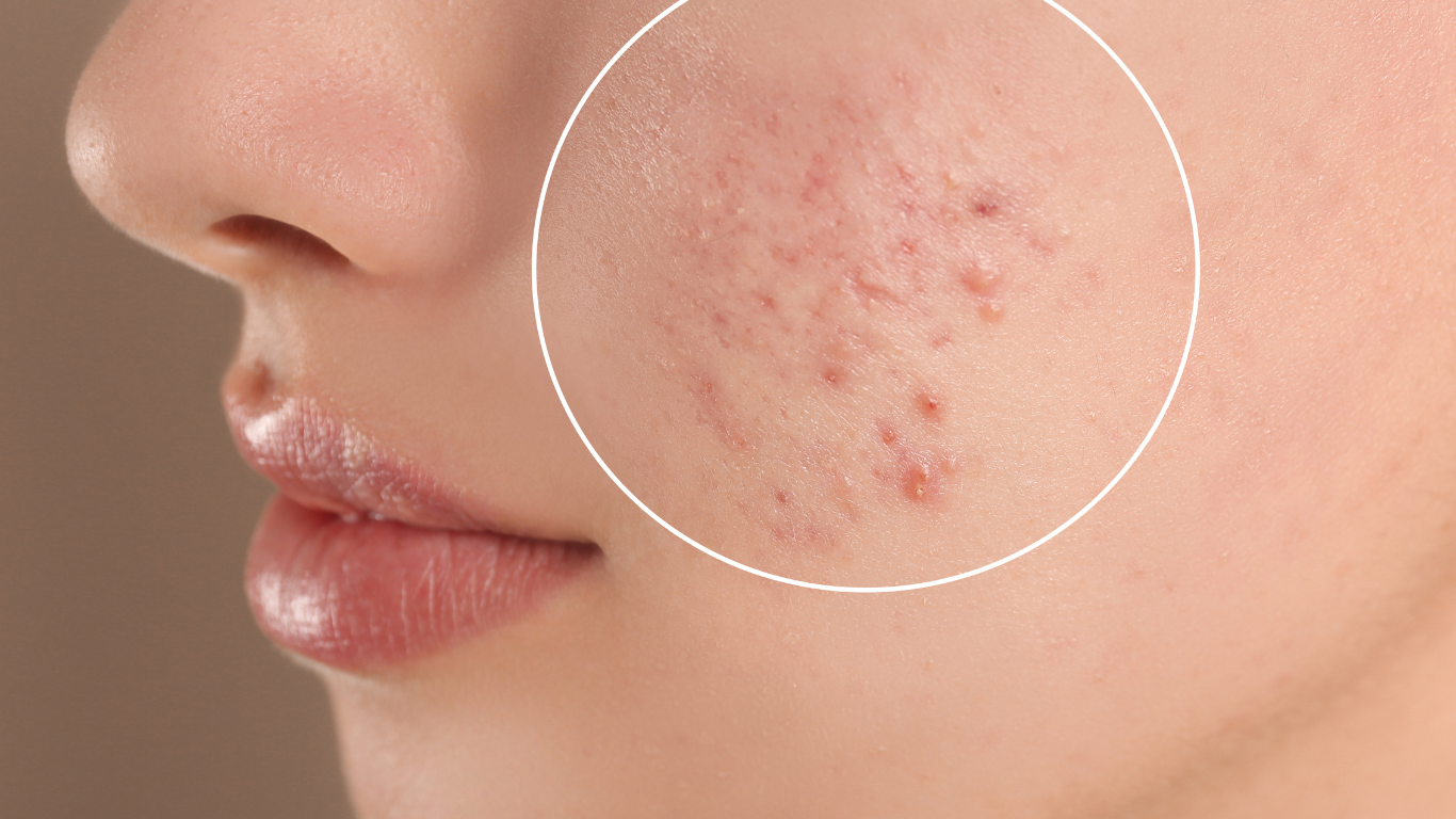 You are currently viewing كيف يُقلل علاج ندبات حب الشباب الاحمرار بسرعة؟