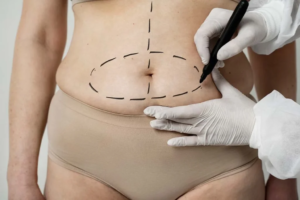 Read more about the article ما هي فوائد جراحة السمنة الآن؟