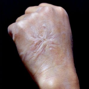 Read more about the article هل تستحق جراحة ترميم الحروق التفكير فيها؟