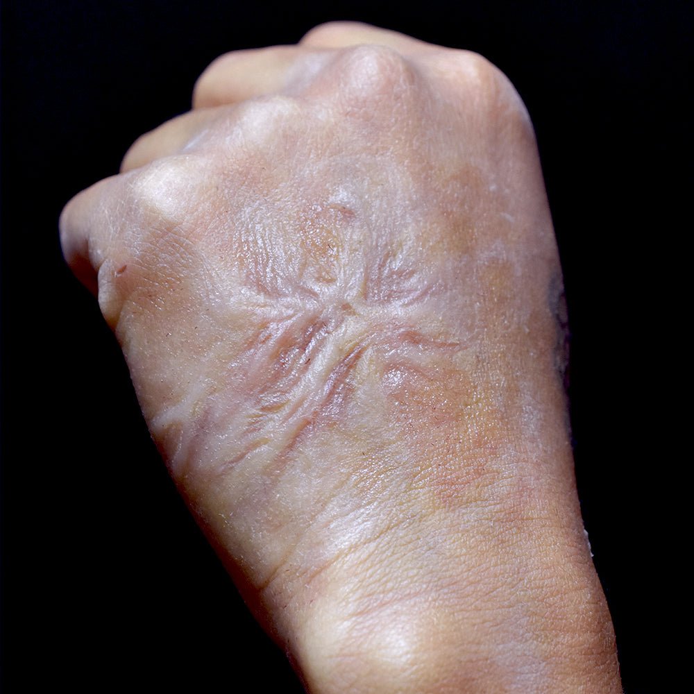 You are currently viewing هل تستحق جراحة ترميم الحروق التفكير فيها؟