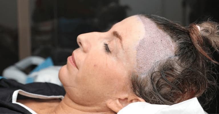 You are currently viewing هل زراعة الشعر للنساء مؤلمة أم مريحة؟