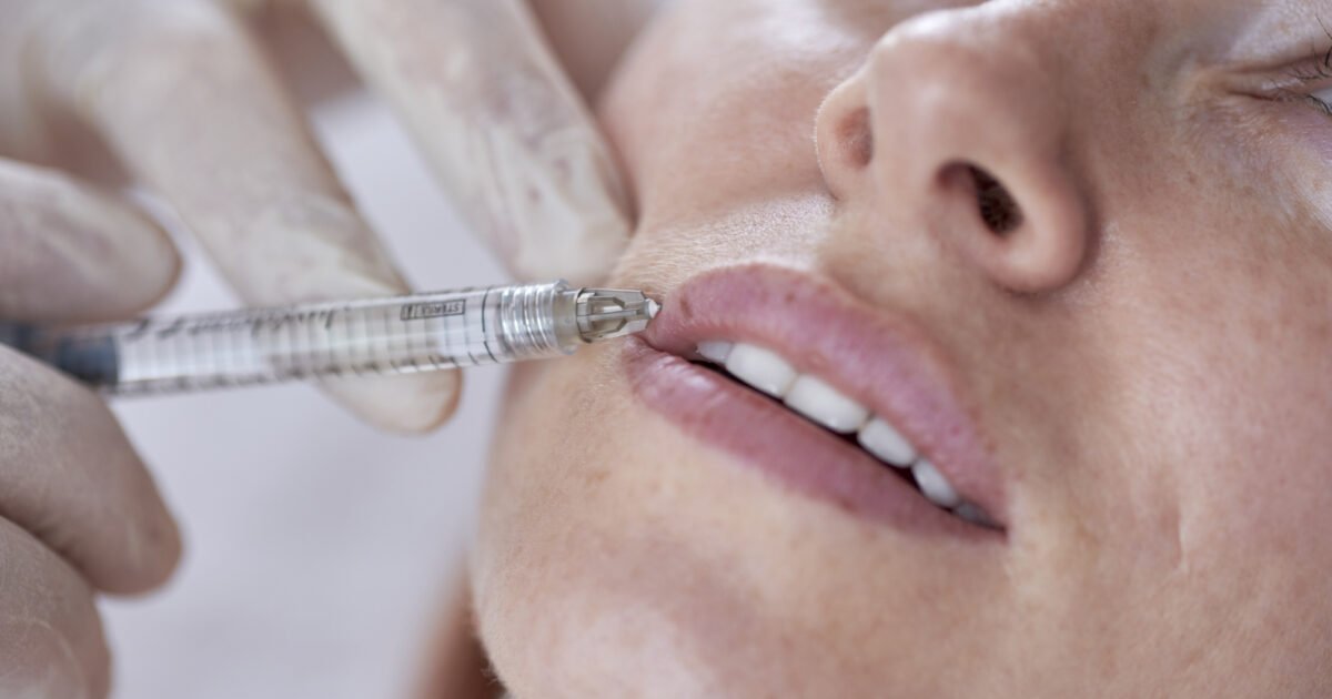 You are currently viewing Achieve Balanced Lips with Lip Fillers Injection