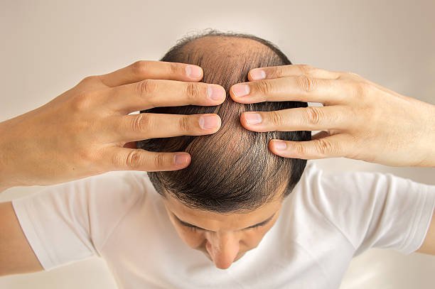 You are currently viewing Can Hair Loss Treatment Treat Genetic Baldness?