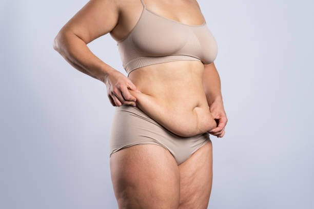Read more about the article Can Tummy Tuck Help Remove Stubborn Belly Skin?
