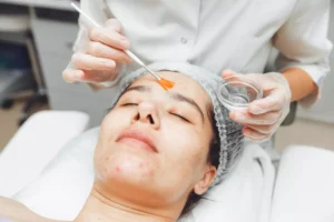 Read more about the article Unlock Radiant Skin with Professional Chemical Peels in Dubai