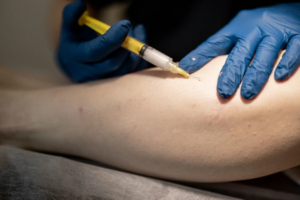 Read more about the article Clearer Skin Starts with Sclerotherapy