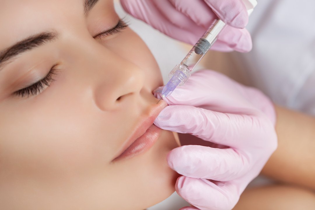 You are currently viewing Dermal Filler  for Lip Enhancement