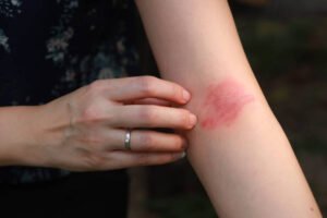 Read more about the article Does Eczema Treatment Control Allergies?