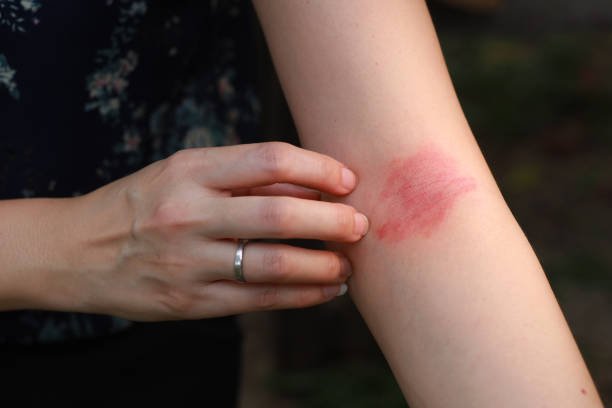 You are currently viewing Does Eczema Treatment Control Allergies?