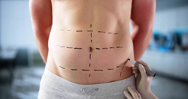 Read more about the article Does Tummy Tuck Surgery Remove Belly Fat?