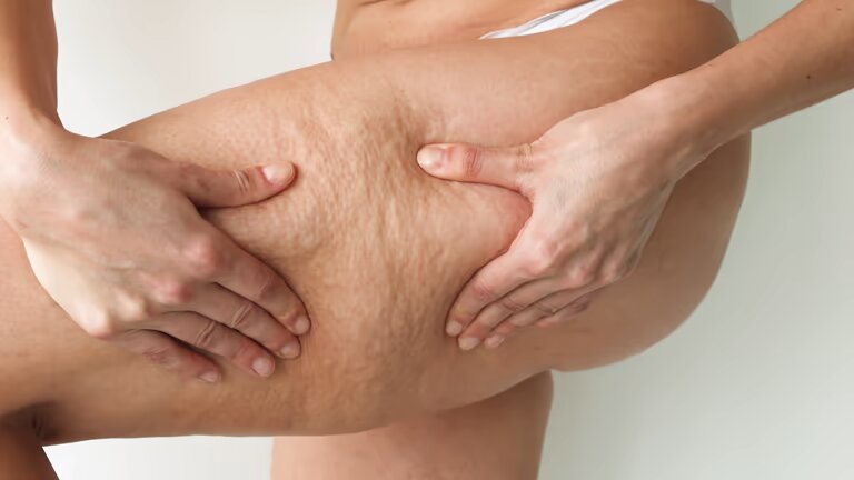 You are currently viewing Does a Thigh Lift Leave Permanent Scars?